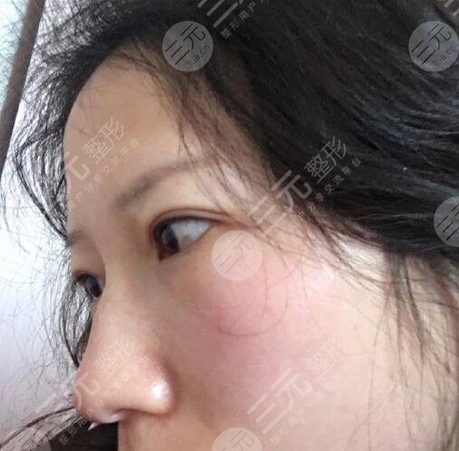 华山医院激光祛斑怎么样果图