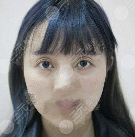 宋保强修复双眼皮案例