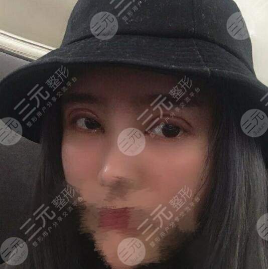 宋保强修复双眼皮案例