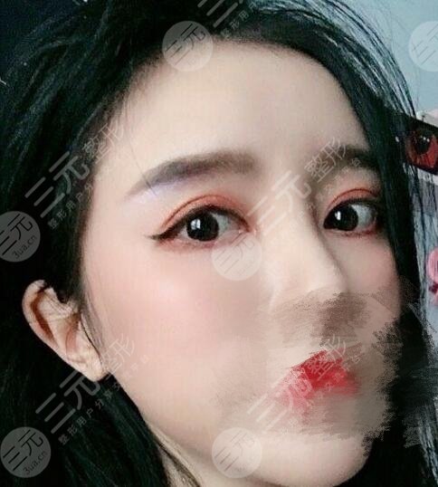 宋保强修复双眼皮案例.