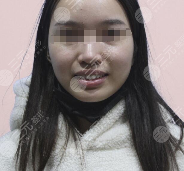 哈医大一院牙齿矫正案例前