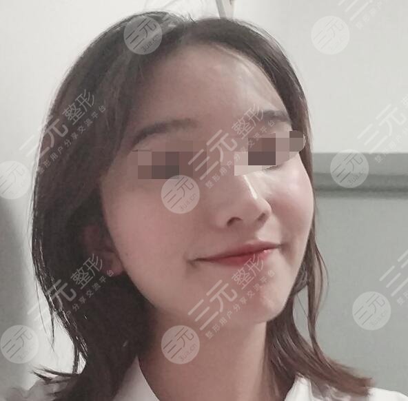 哈医大一院牙齿矫正案例后