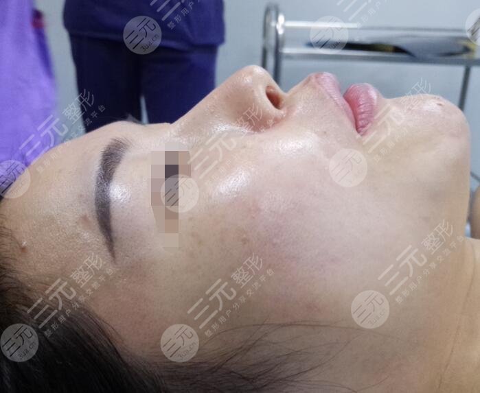 膨体隆鼻真人案例前