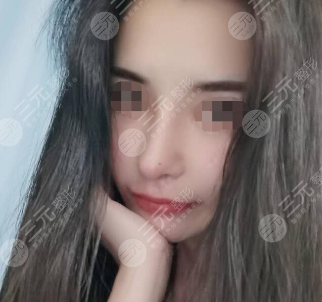 膨体隆鼻真人案例后