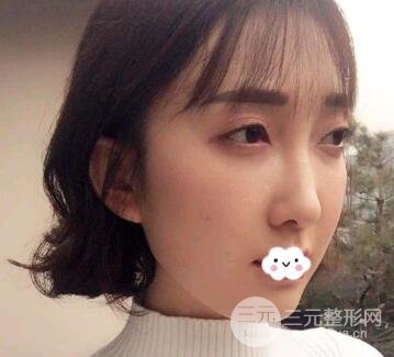 除皱案例