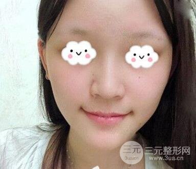 鼻部整形对比图