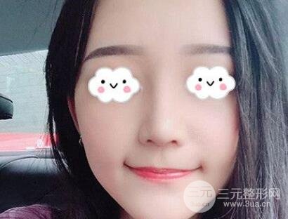鼻部整形对比图