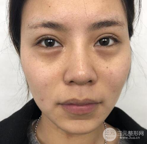 歪鼻矫正