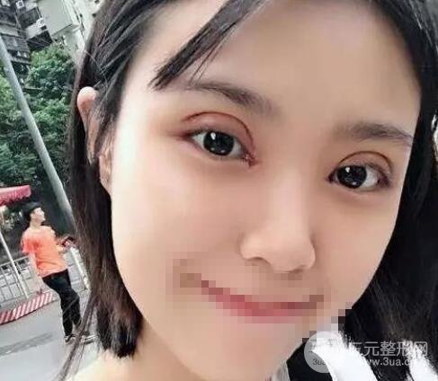 全切双眼皮