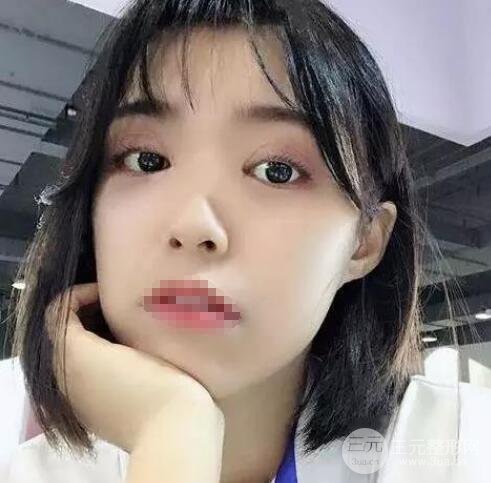 全切双眼皮