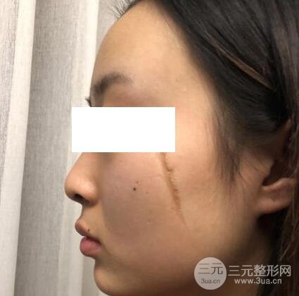 激光祛疤痕手术案例
