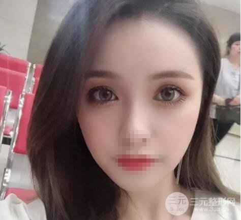 埋线双眼皮手术案例