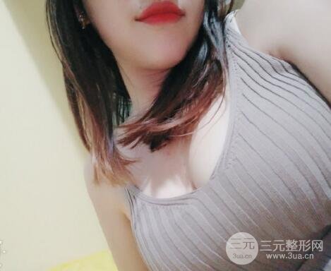 自体脂肪填充乳房