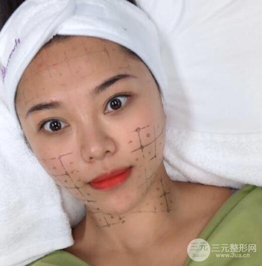 面部拉皮除皱