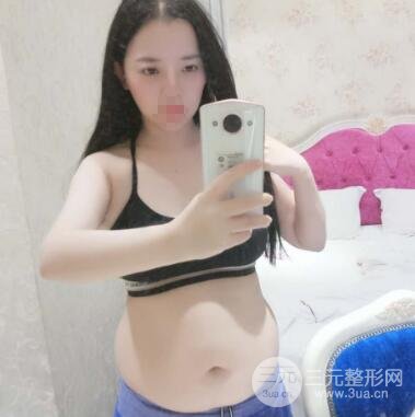 水动力腰腹环吸脂