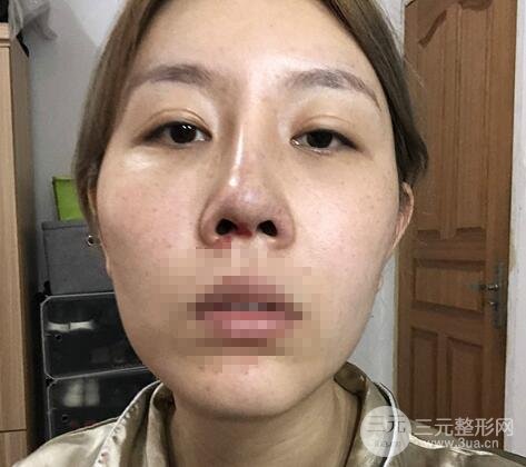 鼻部综合整形