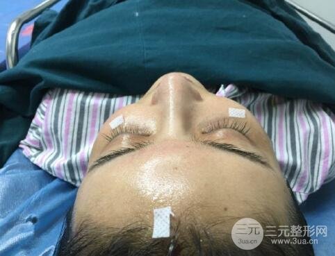 自体脂肪面部填充
