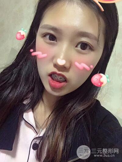 美康口腔门诊部牙齿矫正案例
