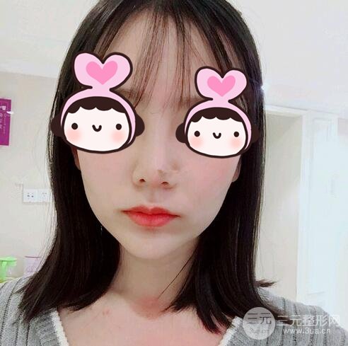 隆鼻整形案例