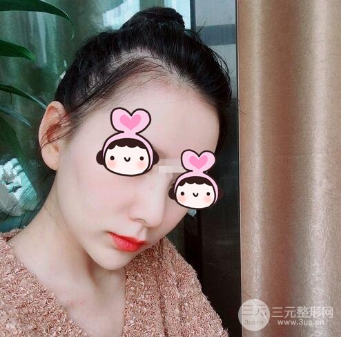 隆鼻整形案例