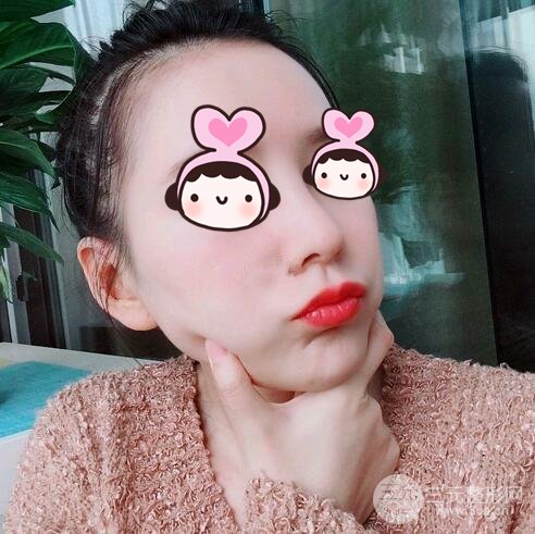 隆鼻整形案例