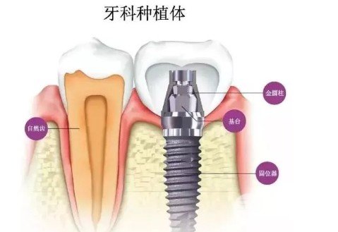 温州医科大口腔医院种植牙