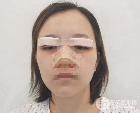 徐州四院整形医院双眼皮隆鼻案例