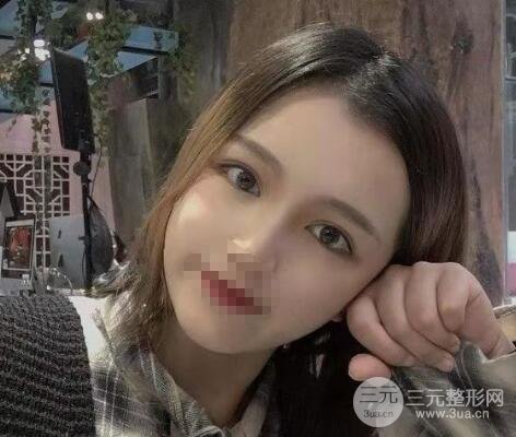 徐州四院整形医院双眼皮隆鼻果图 价格