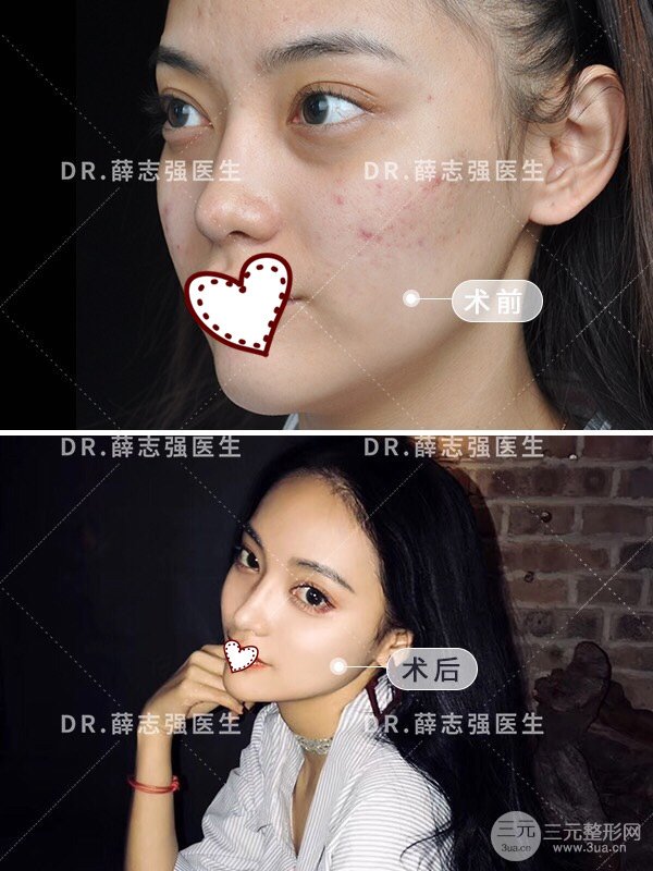 薛志强隆鼻案例