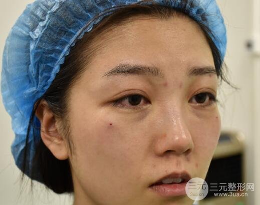 激光祛眼袋案例