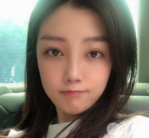 激光祛眼袋案例