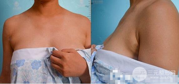 去副乳手术案例