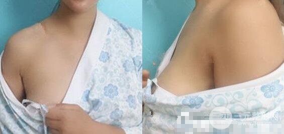 去副乳手术案例