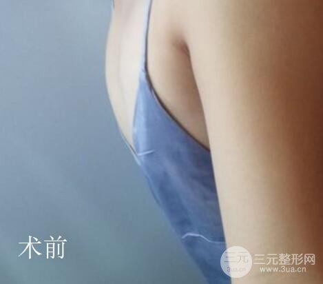 假体隆胸案例