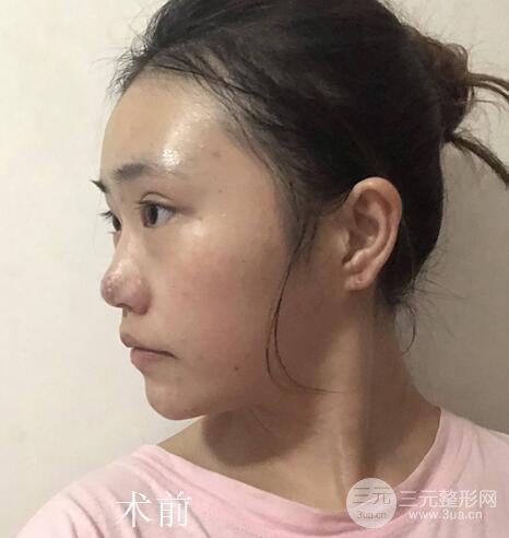 肋软骨隆鼻案例
