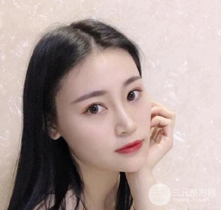 隆鼻案例