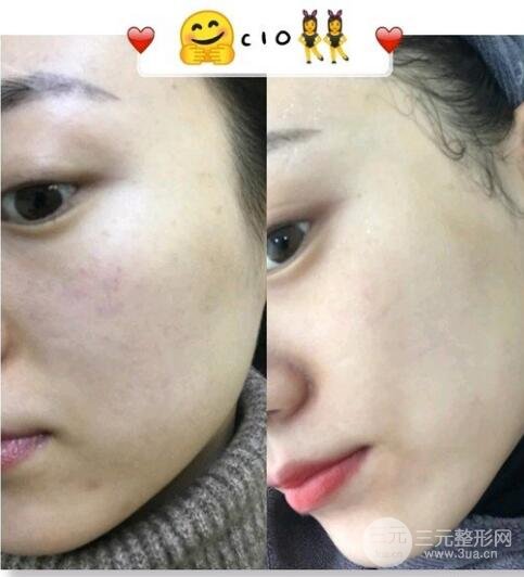 激光美肤案例