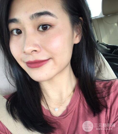 光子嫩肤案例