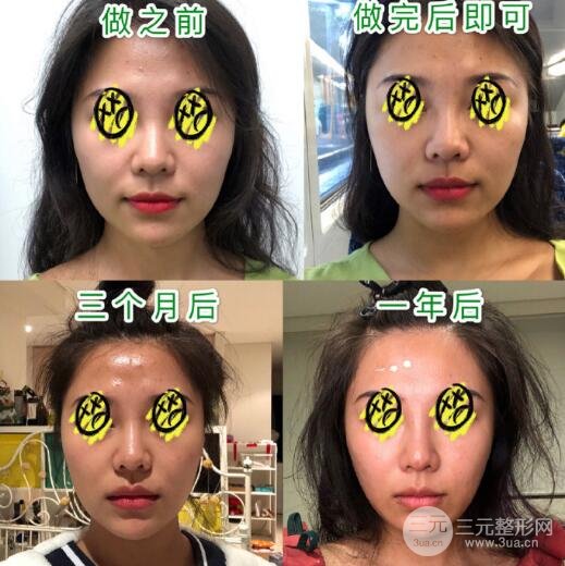 光子嫩肤