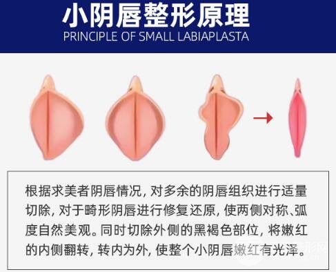 什么是私密整形