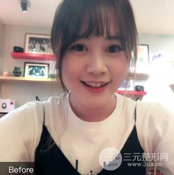 [在线获取]无锡人民医院美容点痣价格表，医生名单&案例~
