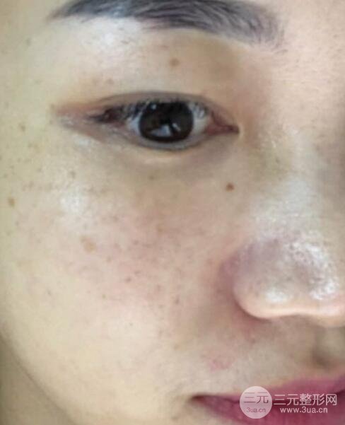 激光祛斑经历分享