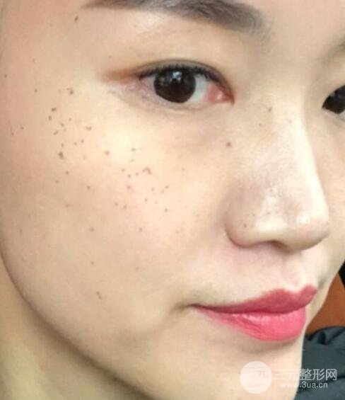 激光祛斑经历分享