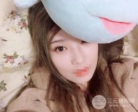 面部吸脂