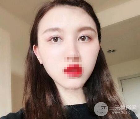 双眼皮全切