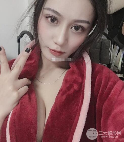 隆胸案例