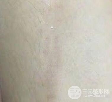 疤痕祛除案例