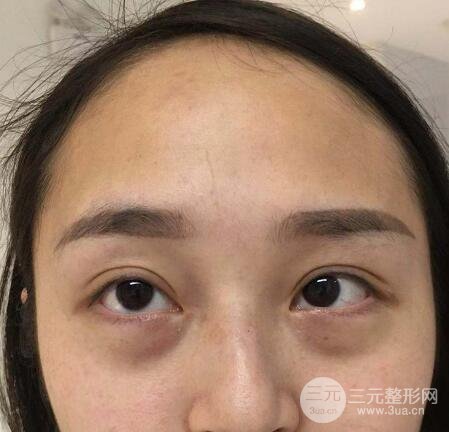 去眼袋
