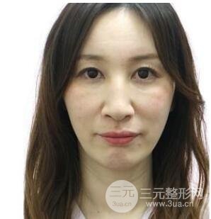 除皱对比图