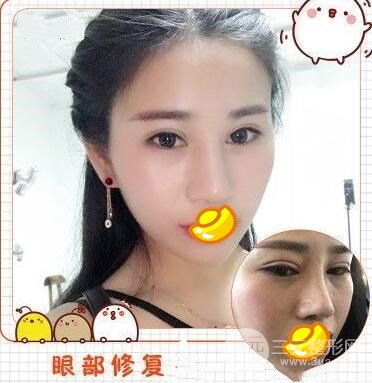 哈尔滨解放军211医院整形科双眼皮修复案例